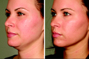 �����! �������������� smas Lifting(���� �������) �� �������� Ulthera �� �������! - ����������� 1